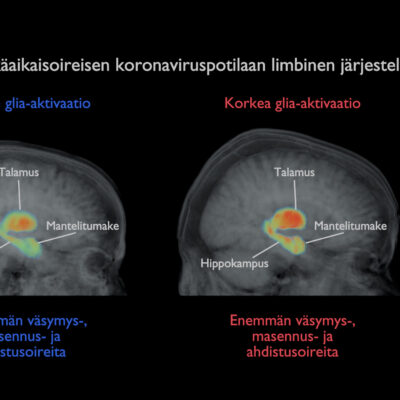 Aivotulehdus on epätodennäköinen syy pitkittyneisiin koronaoireisiin