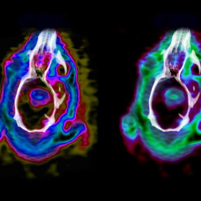 New Discovery Can Help Detect Brain Tumours