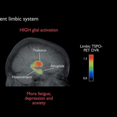 Brain inflammation is unlikely to explain persistent long COVID symptoms