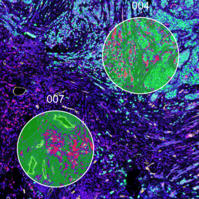 New study advances cancer precision therapies by identifying patients who benefit from Bexmarilimab treatment