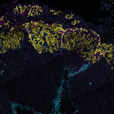 Breast cancer remodels lymphatic vessels to accelerate its spreading