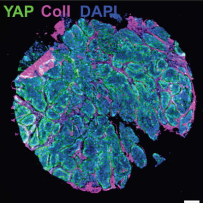 Researchers played music to cells – aggressiveness of laryngeal cancer decreased