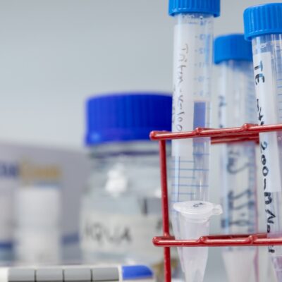 Aggressiivinen suusyöpä voidaan tunnistaa imusuonien muutoksista jo varhaisessa vaiheessa