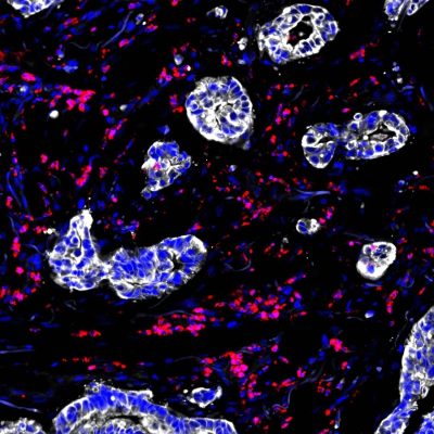 Syöpälääke beksmarilimabi aktivoi valkosolut immuunijärjestelmältä piiloutuvissa kasvaimissa