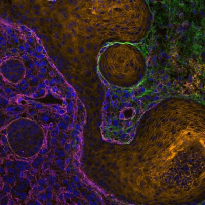 Researchers at Åbo Akademi University discover a new mechanism driving breast cancer progression