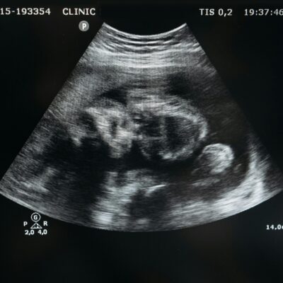 Pertussis vaccination during pregnancy increases quantity and quality of antibodies protecting the baby